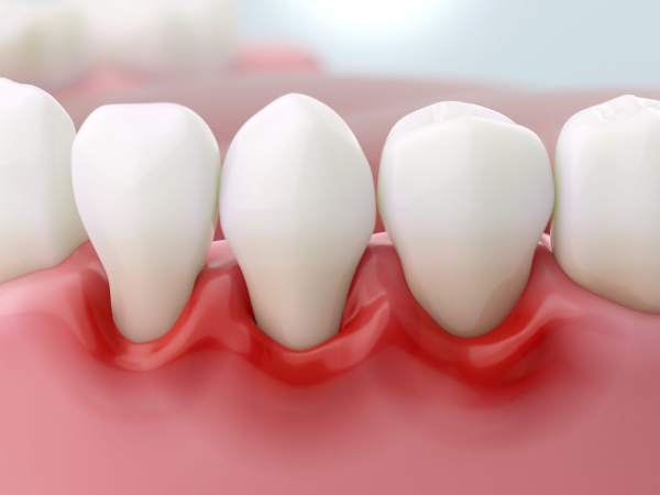 Maggok Dental_2. Why root planing and curettage are needed when scaling is not enough image 5