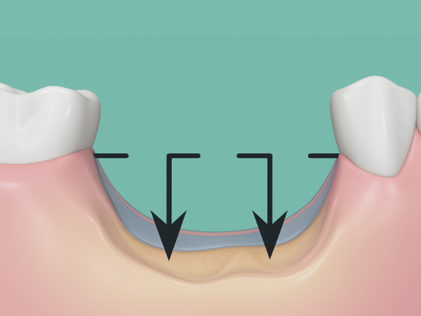 마곡동치과_1. 임플란트 치료에 관련 이미지 2