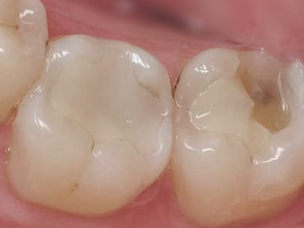 마곡역치과_&ldquo;이렇게 관리하면 오래 씁니다"[ 4. 레진 치료 후 주의사항 ] 관련 이미지 6