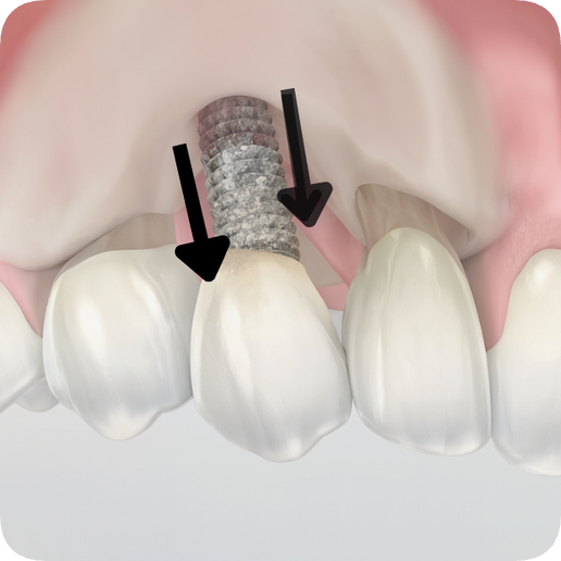 마곡동치과_&ldquo;지금도 늦지 않았다!" [ 4. 임플란트 주위염 치료법 ] 관련 이미지 4