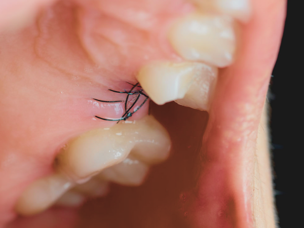 Magok Station Dental Clinic_7. Suture Removal Timing and Care After Implant Surgery image 1