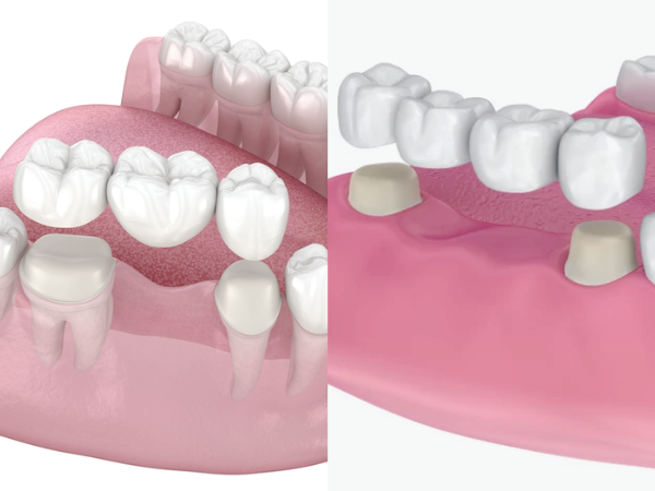 마곡역치과_2. 브릿지 치료, 누가 하면 좋을까요? 가능한 경우와 판단 기준 정리 관련 이미지 1