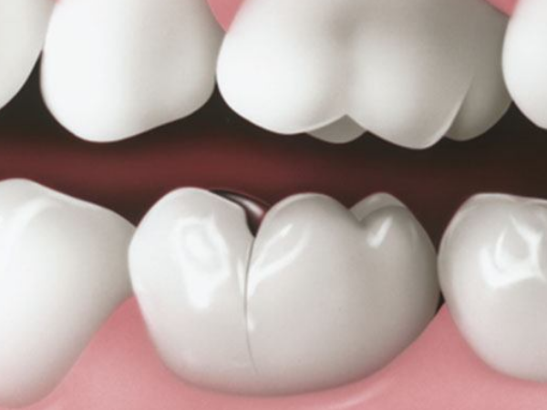 마곡동치과_"붓고 고름이 나와요" [1. 잇몸 고름 주머니 원인] 관련 이미지 6