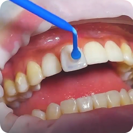 [ Magok Veneers_04 ] How Does the Veneer Treatment Process Proceed from Start to Finish? image 4