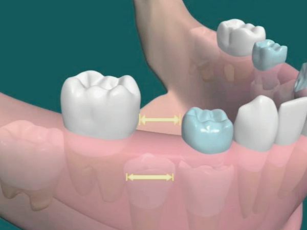마곡역치과_2. 유치기 어린이(4~7세) 충치 예방, 부모가 꼭 알아야 할 구강 관리법 관련 이미지 2