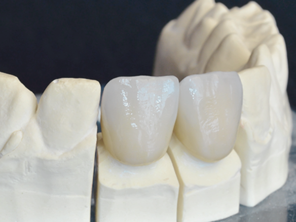 마곡동치과_ 1. 크라운 치료가 필요한 5가지 경우 관련 이미지 6