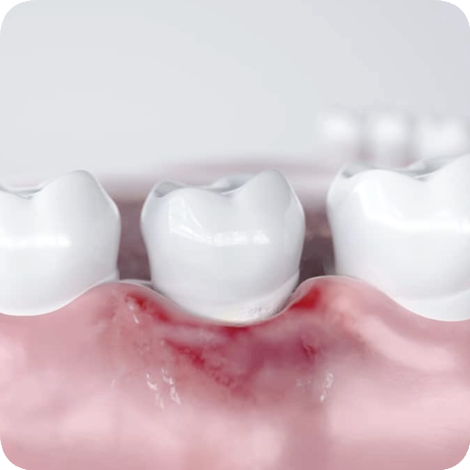 마곡동치과_3. 치주질환 자가진단 체크! 내 잇몸은 안전할까? 관련 이미지 2