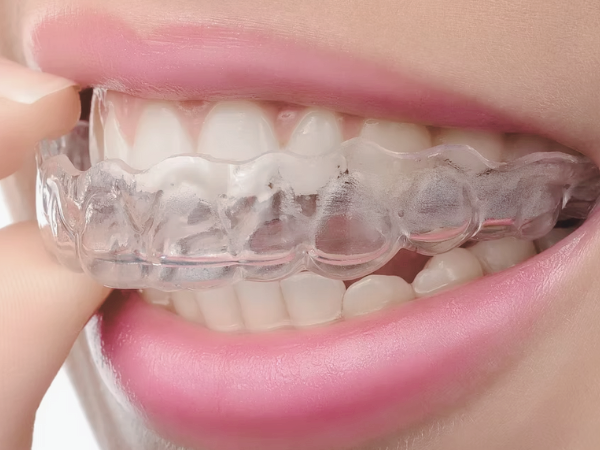 마곡동치과_집에서도 할 수 있는 치아미백? [ 4. 생활치 자가미백 특징과 과정 ] 관련 이미지 3