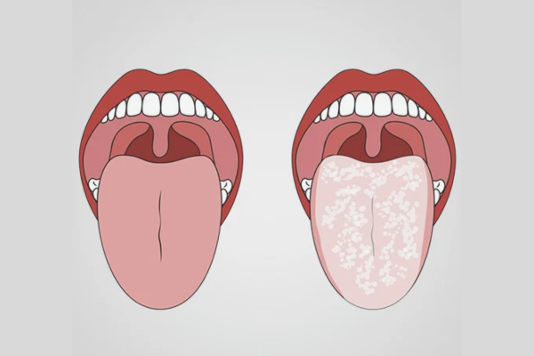 마곡역치과_7. 혀 클리너 꼭 써야 할까요? 설태 생기는 진짜 이유와 올바른 사용 기준 관련 이미지 2