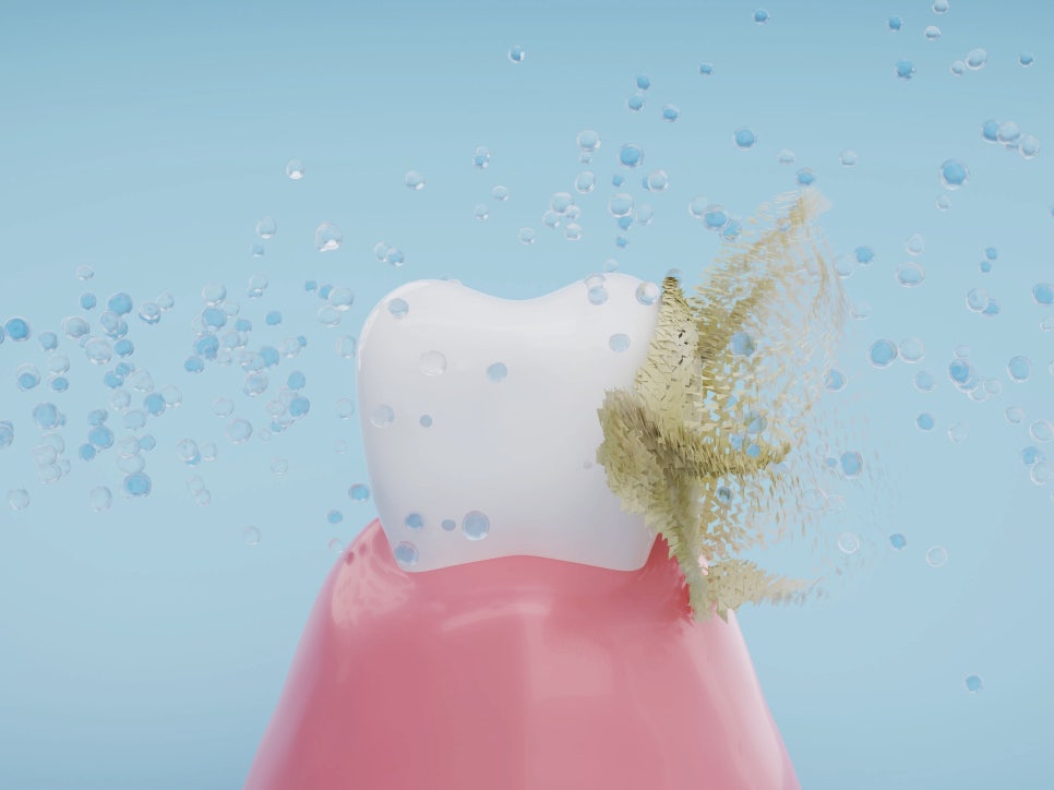 마곡역치과_ 1. 스케일링 꼭 받아야 하나요? 치석 제거부터 잇몸병 예방까지 효과 총정리 관련 이미지 5