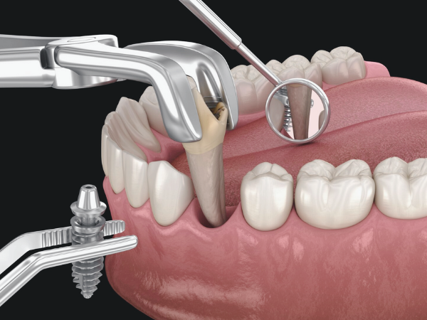 마곡동치과_ &ldquo;안전한 준비, 깔끔한 진행!&rdquo; [ 4. 당일 임플란트 수술 과정 ] 관련 이미지 3