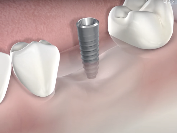마곡동치과_3. 기초부터 튼튼하게, 뼈이식 임플란트 진행 과정 관련 이미지 4