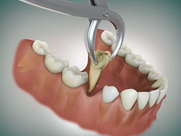 마곡역치과_ &ldquo;참으면 더 커지는 통증?&rdquo; [2. 치수염 치료] 관련 이미지 3
