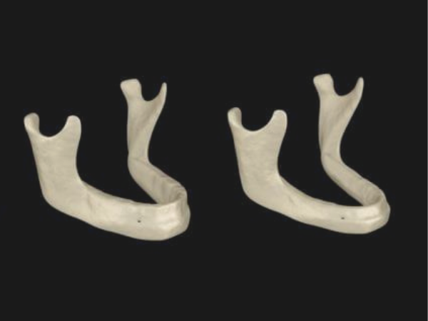 Magok-dong Dental Clinic_2. How Is It Different from Dentures? 5 Advantages of Full-Arch Implants image 5