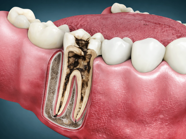마곡역치과_5. 치수염 방치하면 어떻게 될까요? 통증 변화 과정 정리 관련 이미지 3