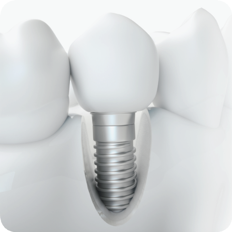 마곡역치과_잃어버린 치아, 그 자리에 다시 &lsquo;내 것 같은&rsquo; 이를! [ 1. 임플란트 기본 구조 ] 관련 이미지 1