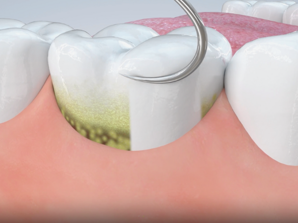 마곡 치과 _2. 씹을 때 치아 통증 치료 방법, 원인에 따라 달라집니다 관련 이미지 3