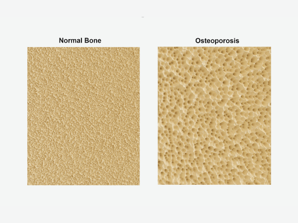 마곡역치과_4. 골다공증이 있으면 치과치료, 정말 조심해야 할까요? 관련 이미지 1