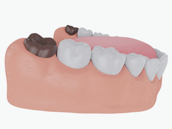 마곡동치과_2.사랑니 방치하면 어떻게 될까? 발치가 필요한 진짜 이유 4가지 관련 이미지 2
