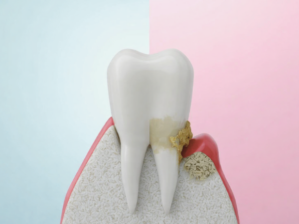 마곡치과_3. 씹을 때 아픈 치아, 그냥 참아도 괜찮을까요? 방치하면 생기는 문제 관련 이미지 3