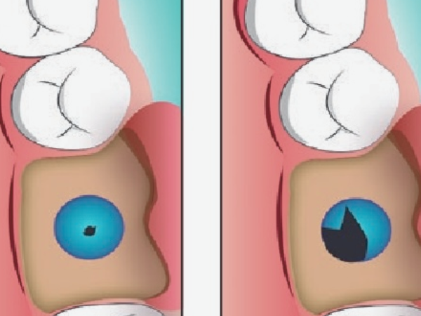 마곡동 치과_2. 상악동거상술 위험한가요? 부작용 현실 기준 정리 관련 이미지 3