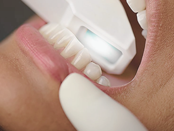 Magok-dong Dental Clinic_ “Taking Dental Impressions with Light!” [5. Digital Impression Taking with a 3D Intraoral Scanner] image 1
