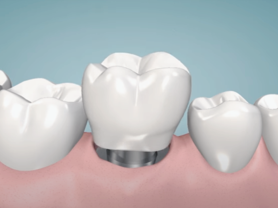 마곡역치과_"씹는 즐거움, 웃는 자신감, 내 이 같은 자연스러움" [ 3. 임플란트 수술과정 ] 관련 이미지 6