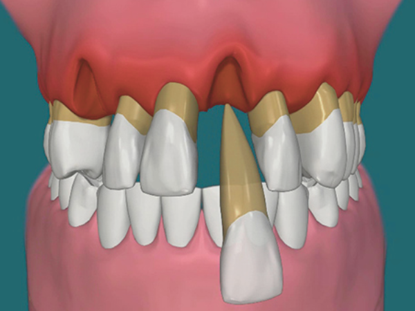 [마곡동치과_치아 흔들림 시리즈 4] 흔들리는 이빨, 어느 정도면 발치를 고려해야 할까요? 관련 이미지 2
