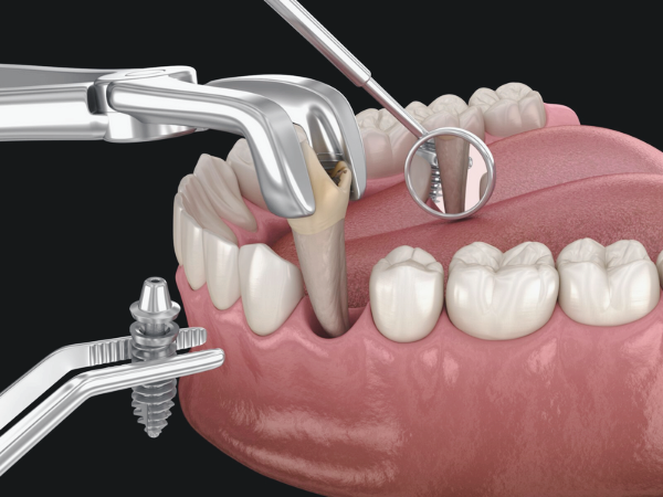 마곡역치과_ &ldquo;참으면 더 커지는 통증?&rdquo; [2. 치수염 치료] 관련 이미지 4