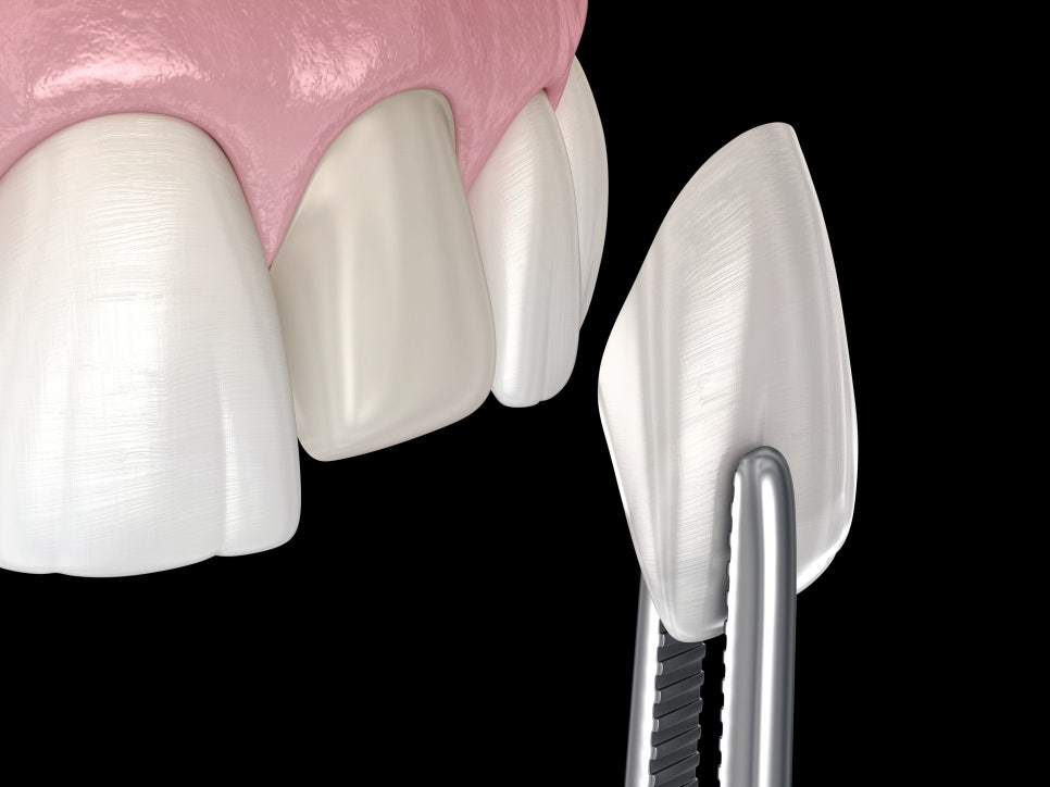 마곡치과_  1. 무삭제 라미네이트가 가능한 경우 ( feat. 디아네이트) 관련 이미지 2