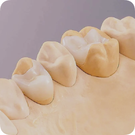 마곡역치과_5. 인레이 보철물 떨어지는 이유 [ 탈락 원인과 재접착 가능한 경우는? ] 관련 이미지 11