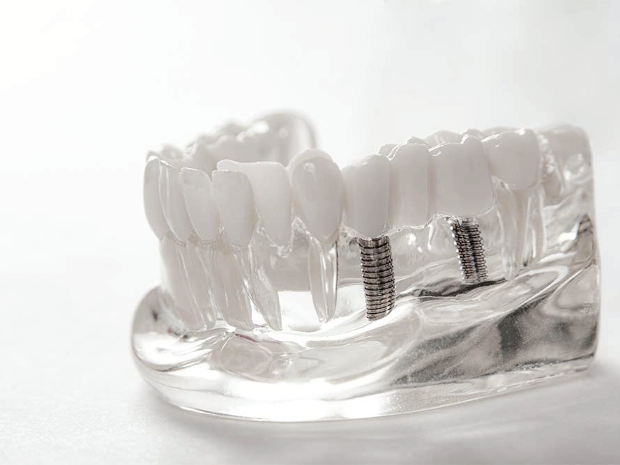 마곡동치과_&ldquo;양치했는데 왜?&rdquo; 숨은 이유 공개! [ 2. 임플란트 주위염 원인 ] 관련 이미지 6