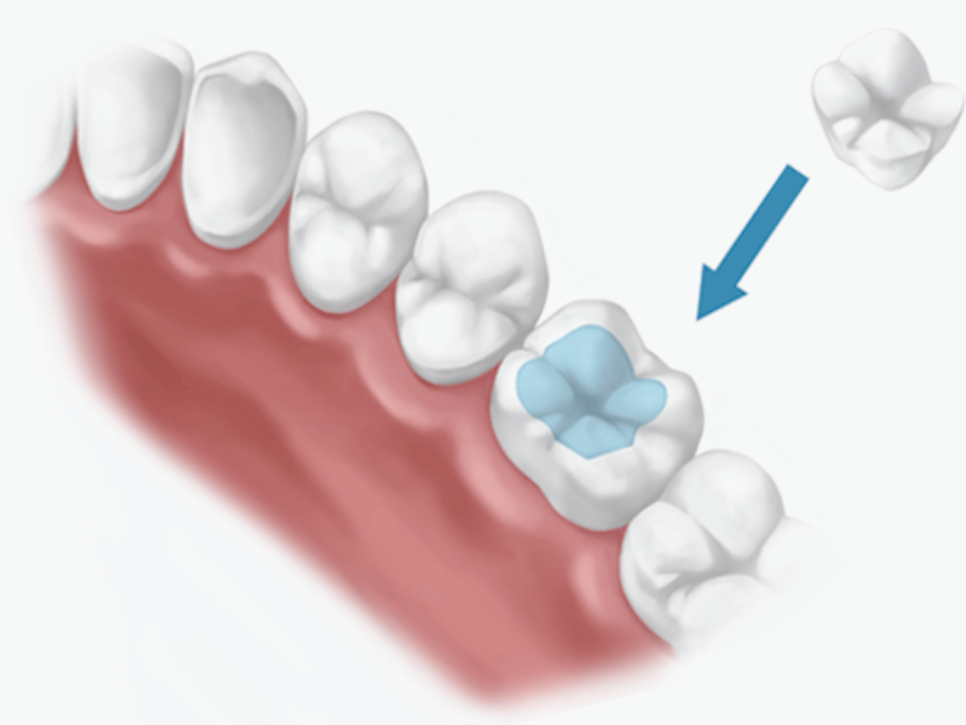 마곡 치과_ 당일 인레이 보철 셋팅 시스템을 소개합니다.( feat. 저스트 스캔) 관련 이미지 1