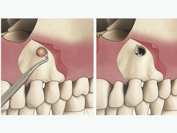 마곡동치과_&ldquo;이빨 뿌리 끝 염증, 이렇게 해결합니다!&rdquo; [2. 치근단절제술 과정] 관련 이미지 4