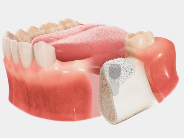 Magok Dental Clinic_ 5. A Complete Guide to Full-Mouth Implant Prices: How Much Will I Actually Pay? image 2