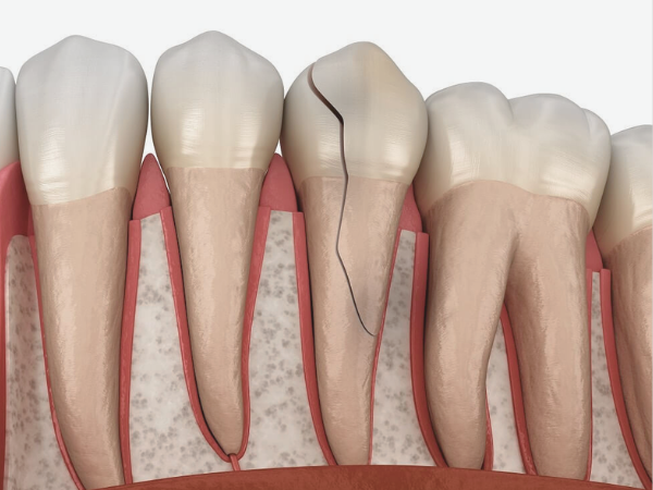 [마곡동치과_치아 흔들림 시리즈 4] 흔들리는 이빨, 어느 정도면 발치를 고려해야 할까요? 관련 이미지 3