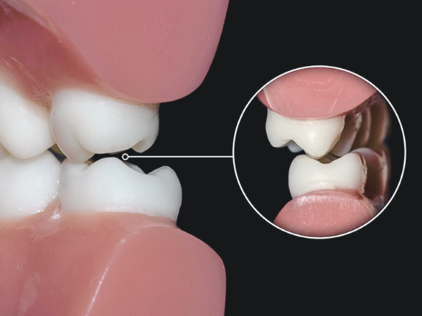 마곡역치과_&ldquo;치료 후 시린 치아, 그냥 두면 될까요?&rdquo; [ 5. 레진 통증 원인과 대처법 ] 관련 이미지 3