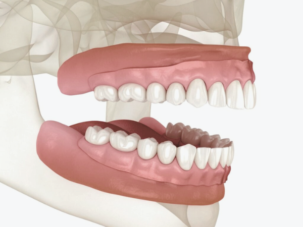 Magok Station Dental Clinic_“What Is Right for Me?” [2. A Complete Guide to Denture Types] image 2