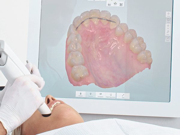 Magok-dong Dental Clinic_ “Taking Dental Impressions with Light!” [5. Digital Impression Taking with a 3D Intraoral Scanner] image 3