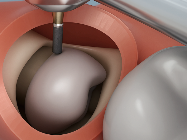 마곡동치과_7. 사랑니 발치 후 생기는 드라이소켓, 원인과 증상부터 예방법까지 총정리 관련 이미지 6