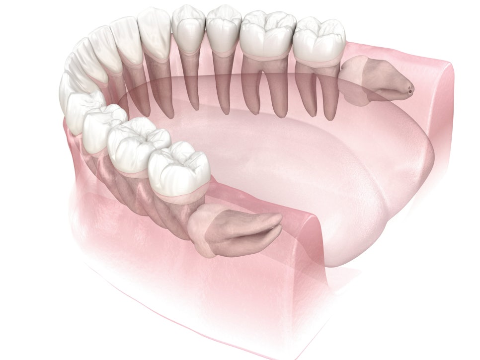 마곡역치과_3. 사랑니에도 종류가 있다? 매복, 수평, 정상 사랑니 비교 관련 이미지 4
