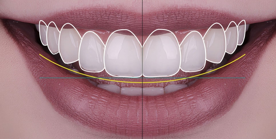 마곡치과_  1. 무삭제 라미네이트가 가능한 경우 ( feat. 디아네이트) 관련 이미지 4
