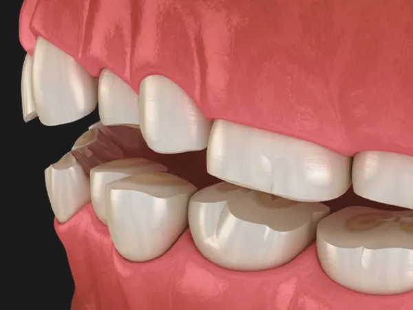 마곡동치과_ "교모, 치경부마모, 침식 중 어디에 해당할까?" [2. 치아마모 종류] 관련 이미지 1