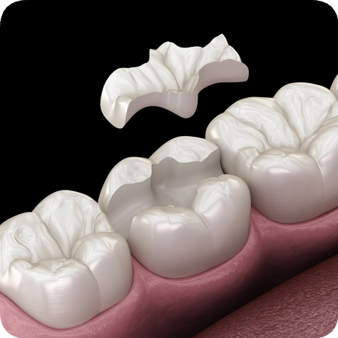 마곡동치과_"방치하면 임플란트까지?" [ 3. 충치 진행 단계별 치료 ] 관련 이미지 5