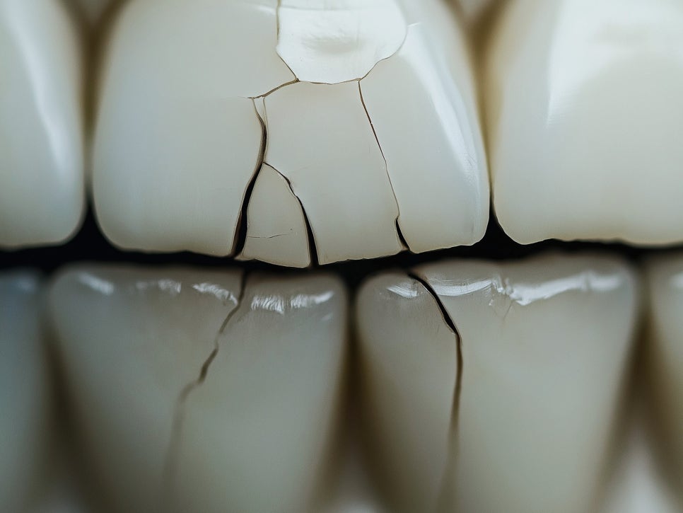 마곡치과_1. 이갈이 장치 필요성과 원리 관련 이미지 3