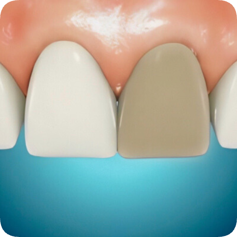 마곡역치과_ 신경이 죽은 치아를 다시 하얗게! [ 2. 실활치 미백&rsquo;의 원리와 과정 ] 관련 이미지 3