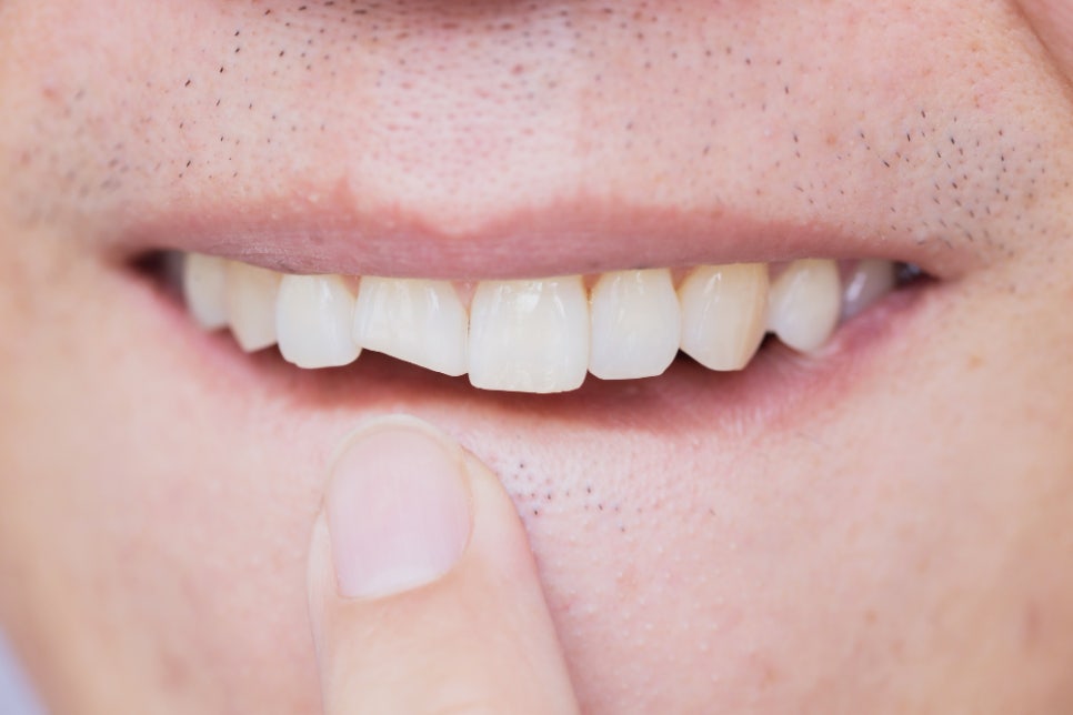 [ Magok Veneers_03 ] When Are Veneers Suitable? A Summary of Indications image 5