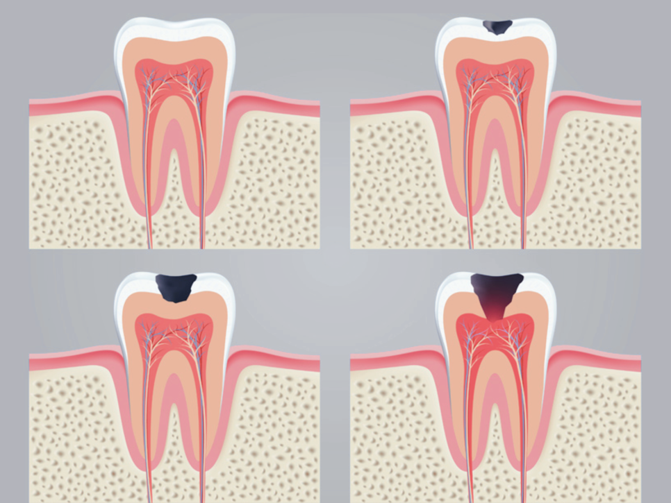 마곡동치과_ &ldquo;아무도 모르게, 아주 조용히&rdquo; [1. 충치가 생기는 과정 ] 관련 이미지 5