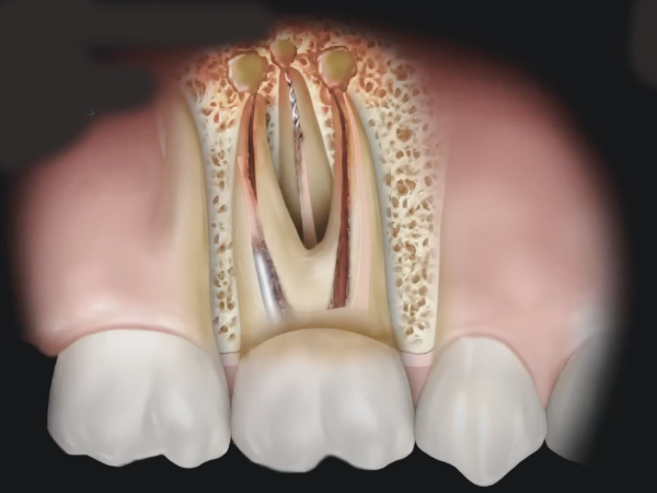 마곡치과_1. 재신경치료 필요한 이유, 신경치료 후 통증 왜 다시 아플까요? 관련 이미지 2