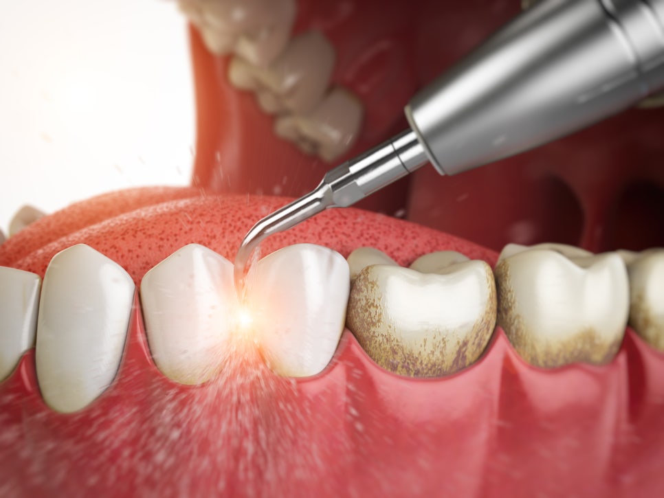 [ Magok Teeth Whitening_07 ] Staining After Teeth Whitening: Just Be Careful of These Things image 9